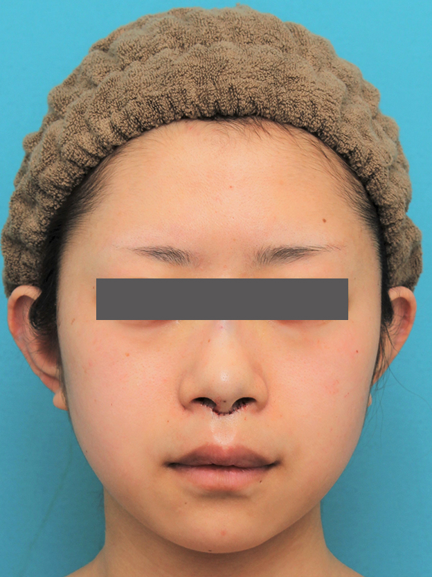 鼻の下を短く（上口唇短縮手術、上口唇リフト、リップリフト、人中短縮術）,人中短縮手術（リップリフト）を行った20代女性の症例写真,手術直後,mainpic_hanashita005b.jpg