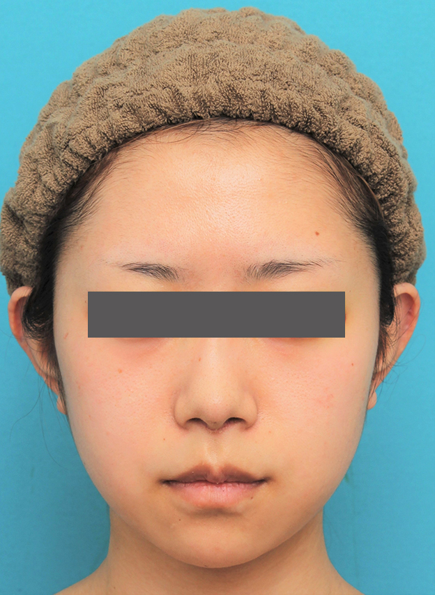 鼻の下を短く（上口唇短縮手術、上口唇リフト、リップリフト、人中短縮術）,人中短縮手術（リップリフト）を行った20代女性の症例写真,6日後,mainpic_hanashita005c.jpg