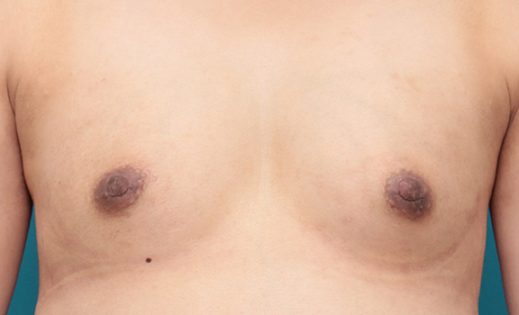 乳頭縮小,30代後半女性の乳頭縮小手術症例写真,After（6ヶ月後）,ba_nyuto021_b01.jpg