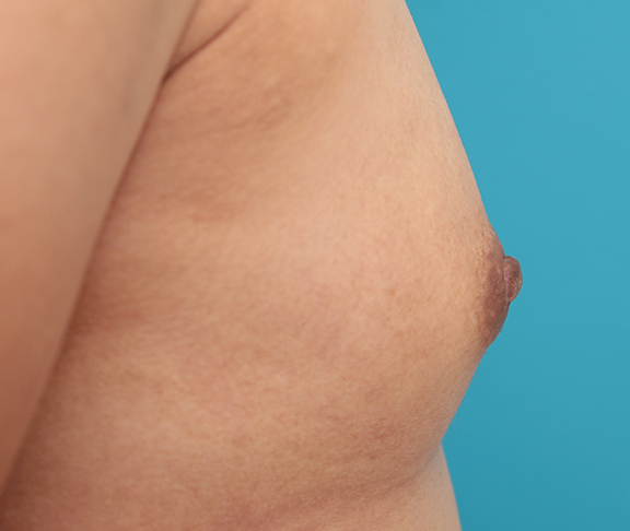 乳頭縮小,30代後半女性の乳頭縮小手術症例写真,After（6ヶ月後）,ba_nyuto021_b03.jpg