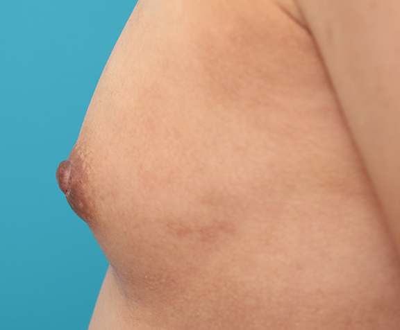 乳頭縮小,30代後半女性の乳頭縮小手術症例写真,After（6ヶ月後）,ba_nyuto021_b05.jpg