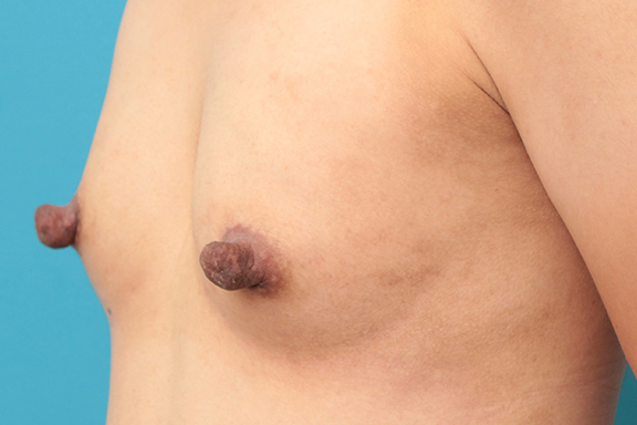 乳頭縮小,30代後半女性の乳頭縮小手術症例写真,Before,ba_nyuto021_b04.jpg
