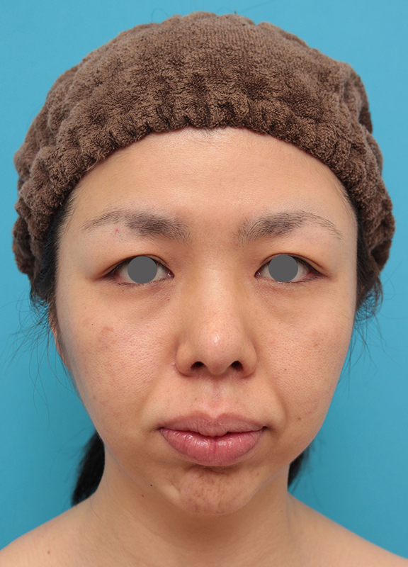 あご形成（シリコンプロテーゼ）,鼻尖形成、耳介軟骨移植、顎プロテーゼ入れの症例写真,After（1年半後）,ba_bisen029_b01.jpg