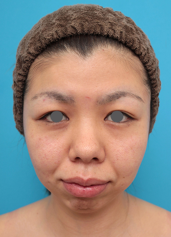 あご形成（シリコンプロテーゼ）,鼻尖形成、耳介軟骨移植、顎プロテーゼ入れの症例写真,Before,ba_bisen029_b01.jpg