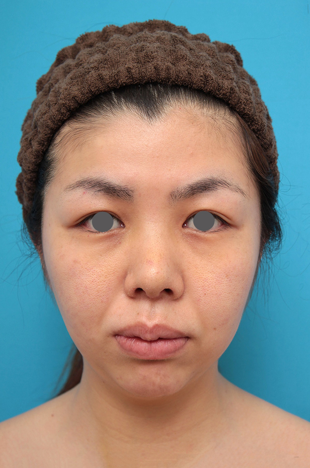 あご形成（シリコンプロテーゼ）,鼻尖形成、耳介軟骨移植、顎プロテーゼ入れの症例写真,1週間後,mainpic_bisen029b.jpg