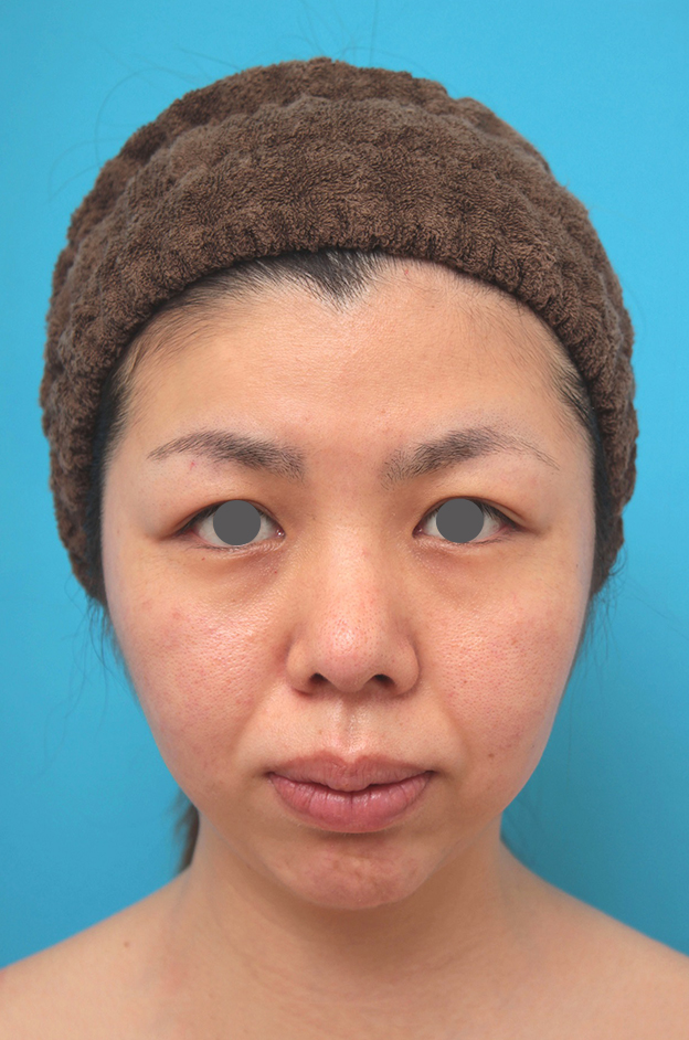 あご形成（シリコンプロテーゼ）,鼻尖形成、耳介軟骨移植、顎プロテーゼ入れの症例写真,1ヶ月後,mainpic_bisen029c.jpg
