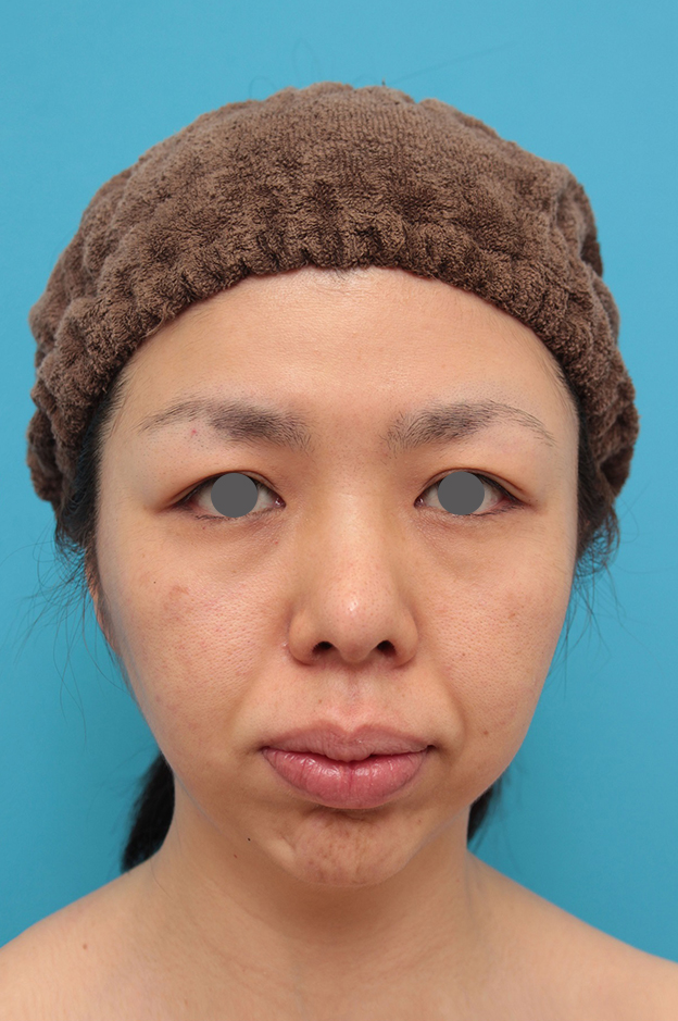 あご形成（シリコンプロテーゼ）,鼻尖形成、耳介軟骨移植、顎プロテーゼ入れの症例写真,1年半後,mainpic_bisen029d.jpg