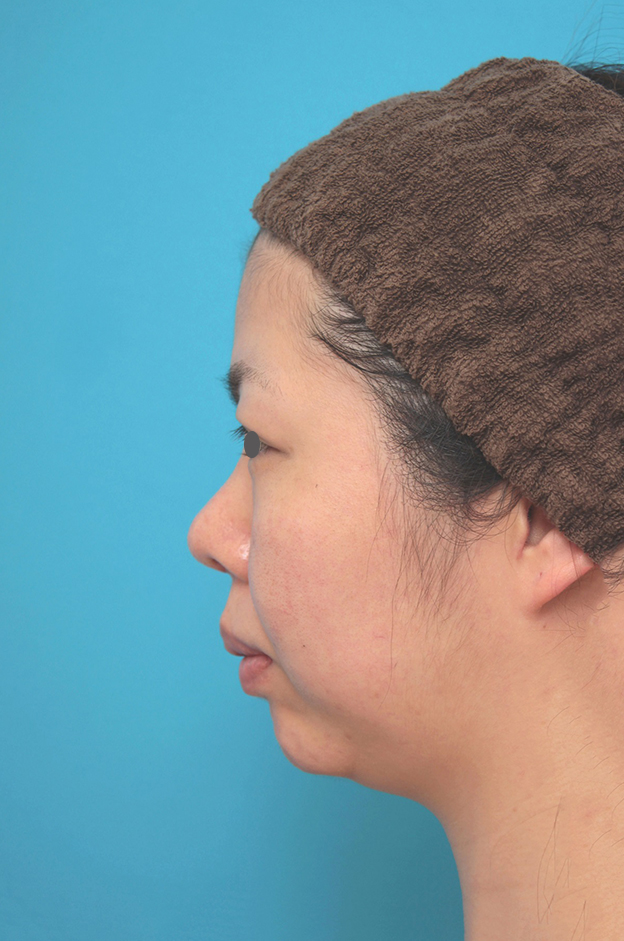 あご形成（シリコンプロテーゼ）,鼻尖形成、耳介軟骨移植、顎プロテーゼ入れの症例写真,1ヶ月後,mainpic_bisen029g.jpg