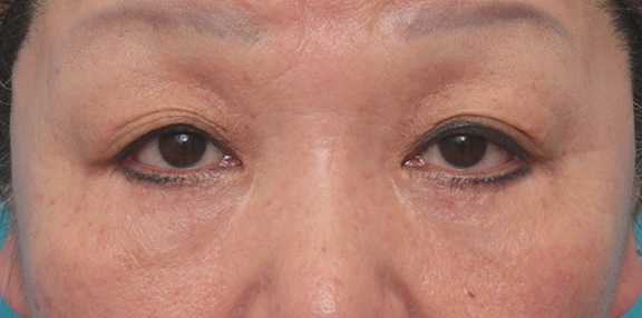 目の下のたるみ取り,目の下のたるみ取りの症例写真,After（6ヶ月後）,ba_tarumi_under002_b01.jpg