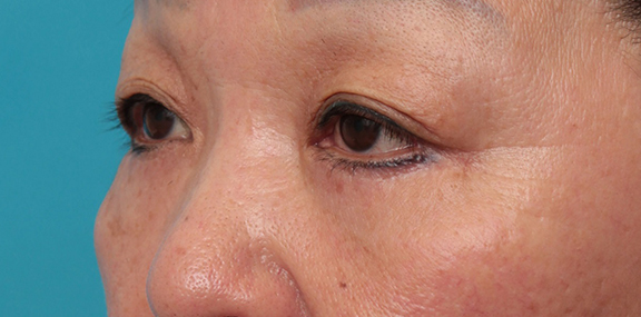 目の下のたるみ取り,目の下のたるみ取りの症例写真,After（6ヶ月後）,ba_tarumi_under002_b02.jpg