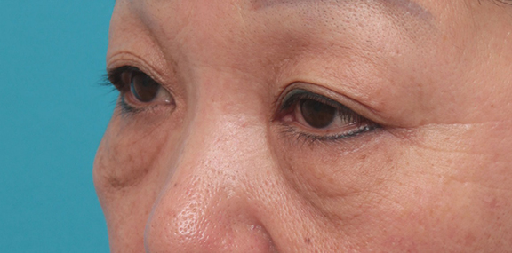 目の下のたるみ取り,目の下のたるみ取りの症例写真,Before,ba_tarumi_under002_b02.jpg