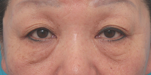 目の下のたるみ取り,目の下のたるみ取りの症例写真,手術前,mainpic_tarumi_under002a.jpg