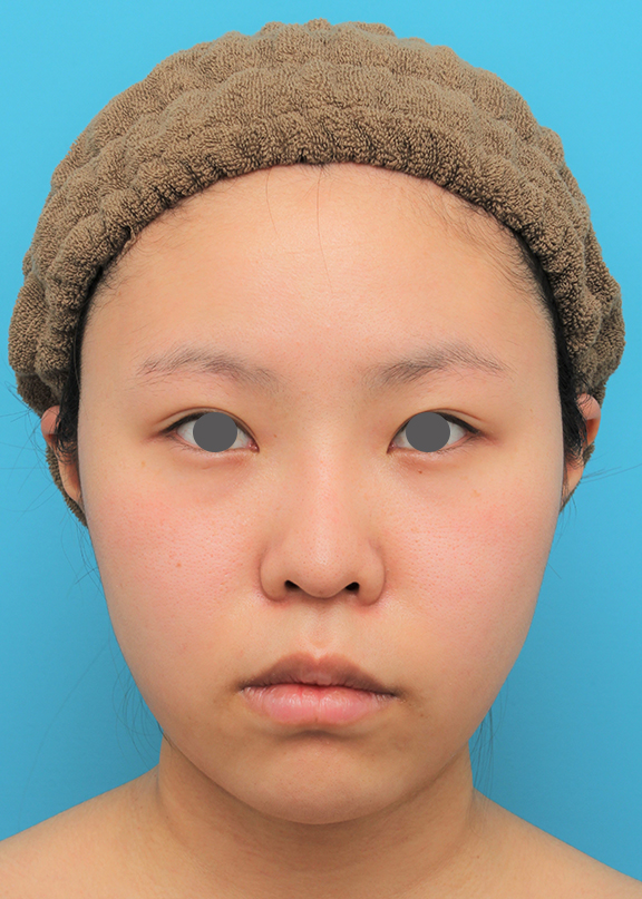 脂肪吸引（頬、あご）,顔（頬～フェイスライン～顎下）の脂肪吸引をした20代女性の症例写真,After（6ヶ月後）,ba_shibo006_b01.jpg