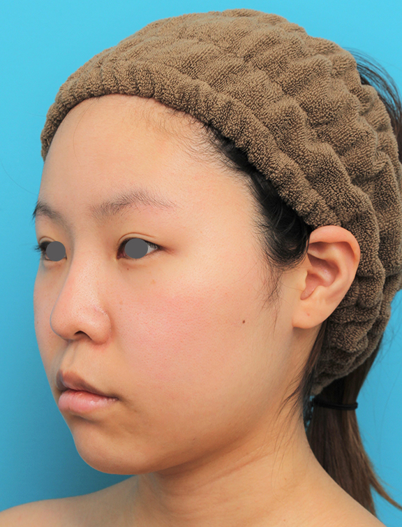 脂肪吸引（頬、あご）,顔（頬～フェイスライン～顎下）の脂肪吸引をした20代女性の症例写真,After（6ヶ月後）,ba_shibo006_b02.jpg