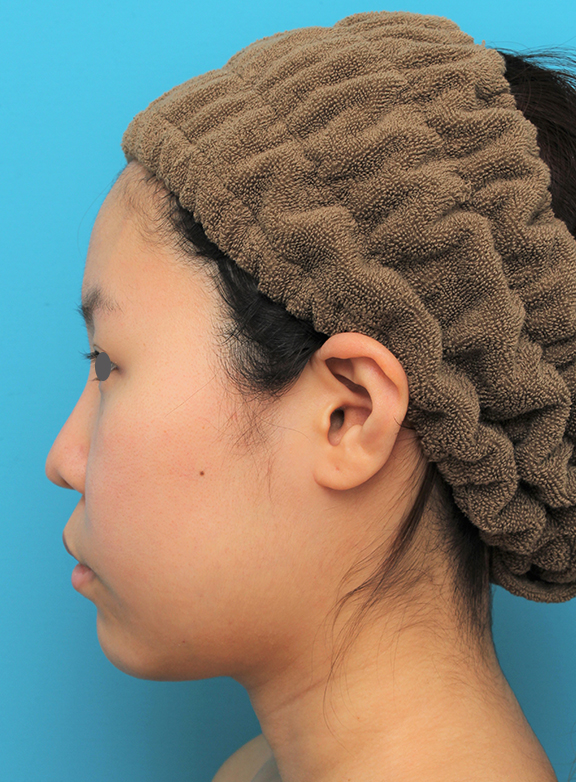 脂肪吸引（頬、あご）,顔（頬～フェイスライン～顎下）の脂肪吸引をした20代女性の症例写真,After（6ヶ月後）,ba_shibo006_b03.jpg