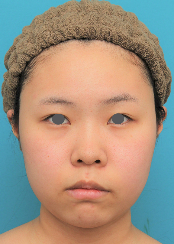 脂肪吸引（頬、あご）,顔（頬～フェイスライン～顎下）の脂肪吸引をした20代女性の症例写真,Before,ba_shibo006_b01.jpg