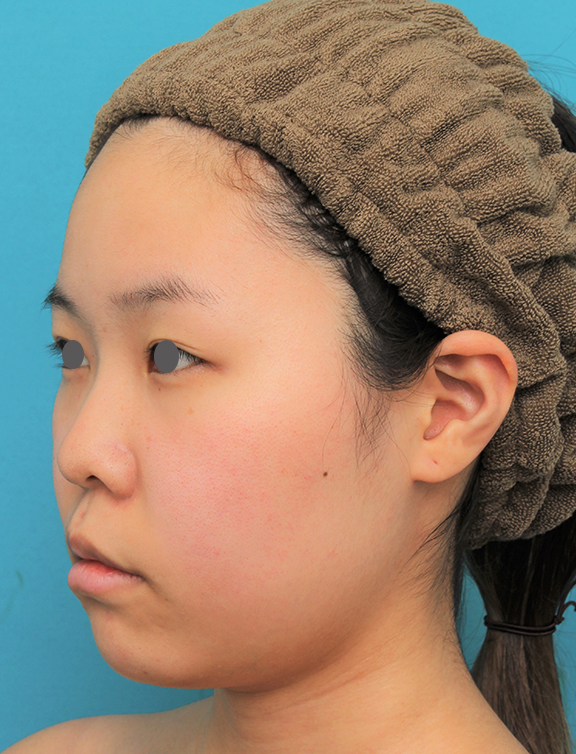 脂肪吸引,顔（頬～フェイスライン～顎下）の脂肪吸引をした20代女性の症例写真,Before,ba_shibo006_b02.jpg