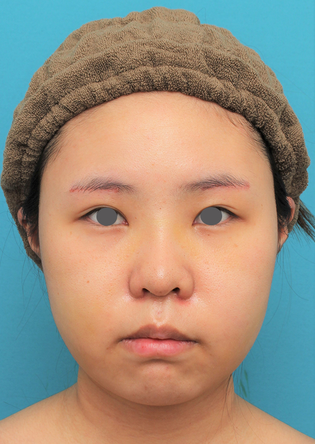 脂肪吸引（頬、あご）,顔（頬～フェイスライン～顎下）の脂肪吸引をした20代女性の症例写真,6日後,mainpic_shibo006c.jpg