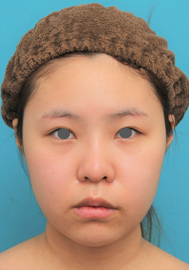 脂肪吸引（頬、あご）,顔（頬～フェイスライン～顎下）の脂肪吸引をした20代女性の症例写真,3週間後,mainpic_shibo006d.jpg
