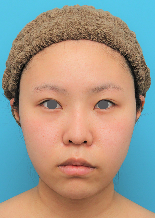 脂肪吸引（頬、あご）,顔（頬～フェイスライン～顎下）の脂肪吸引をした20代女性の症例写真,6ヶ月後,mainpic_shibo006f.jpg
