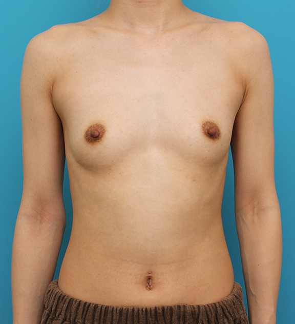 豊胸手術（シリコンプロテーゼ）,シリコンプロテーゼ180ccで豊胸手術した20代女性の症例写真,Before,ba_hokyo035_b01.jpg