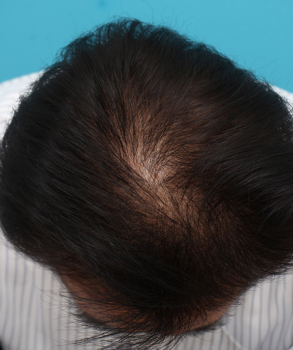 AGA治療（高須式メディカル育毛プログラム）,薄毛治療の症例写真,After（4ヶ月後）,ba_aga029_b01.jpg