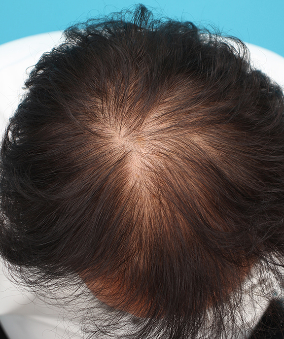 AGA治療（高須式メディカル育毛プログラム）,薄毛治療の症例写真,Before,ba_aga029_b01.jpg