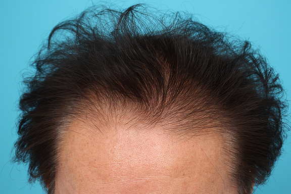 AGA治療（高須式メディカル育毛プログラム）,薄毛治療の症例写真,Before,ba_aga029_b02.jpg
