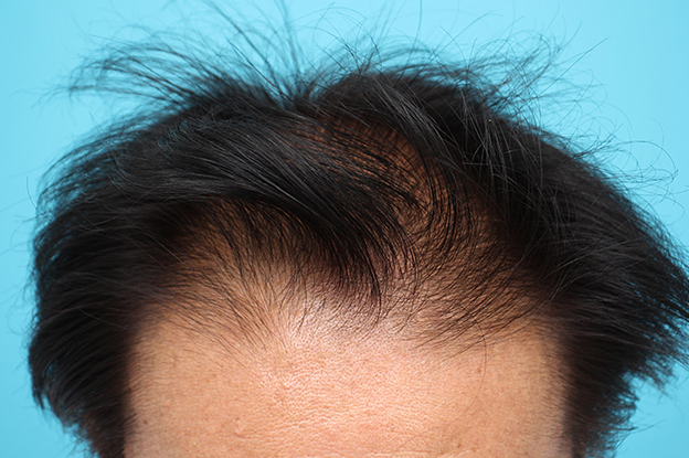 AGA治療（高須式メディカル育毛プログラム）,薄毛治療の症例写真,2ヶ月後,mainpic_aga029b.jpg