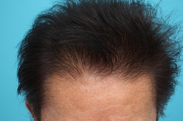 AGA治療（高須式メディカル育毛プログラム）,薄毛治療の症例写真,4ヶ月後,mainpic_aga029c.jpg