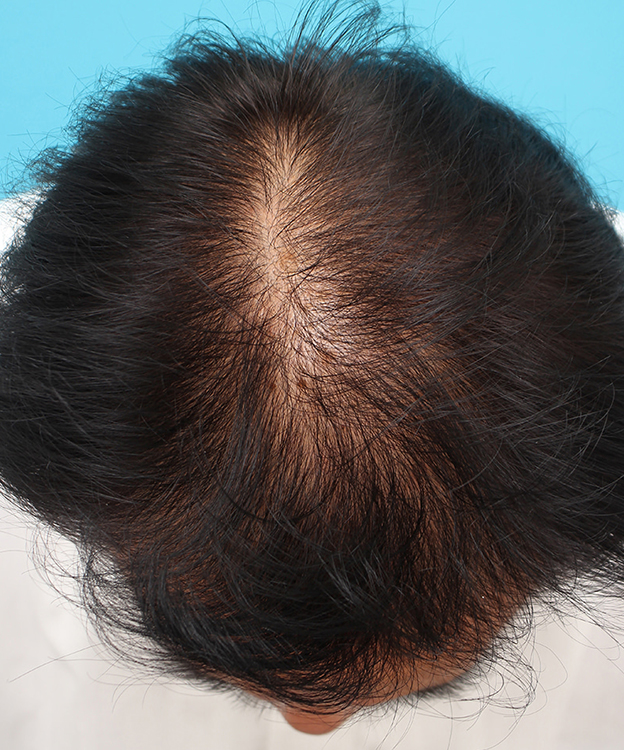AGA治療（高須式メディカル育毛プログラム）,薄毛治療の症例写真,2ヶ月後,mainpic_aga029e.jpg