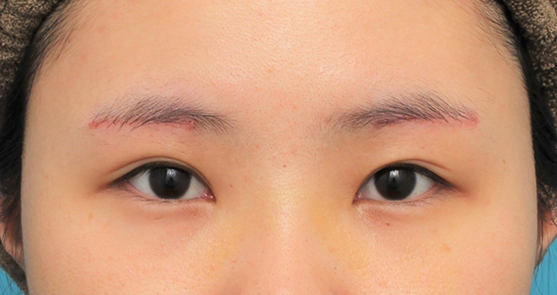 眉下リフト（上眼瞼リフト）,眉下リフト（上眼瞼リフト）を行った20代女性の症例写真,6日後,mainpic_jougankenlift011c.jpg