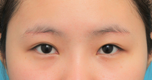 眉下リフト（上眼瞼リフト）,眉下リフト（上眼瞼リフト）を行った20代女性の症例写真,3週間後,mainpic_jougankenlift011d.jpg