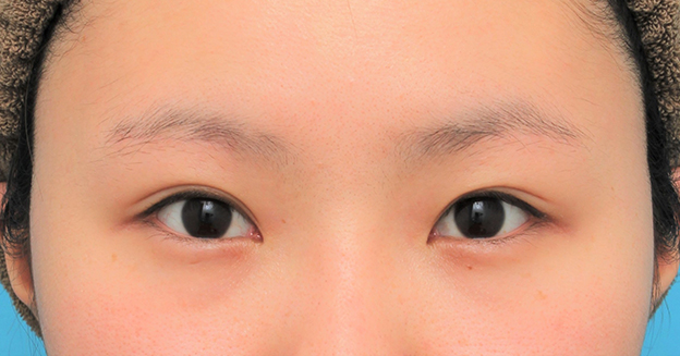 眉下リフト（上眼瞼リフト）,眉下リフト（上眼瞼リフト）を行った20代女性の症例写真,6ヶ月後,mainpic_jougankenlift011f.jpg