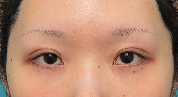 なみだ袋形成（ヒアルロン酸注射）,涙袋ヒアルロン酸注射を行った20代女性の症例写真,Before,ba_namida016_b01.jpg