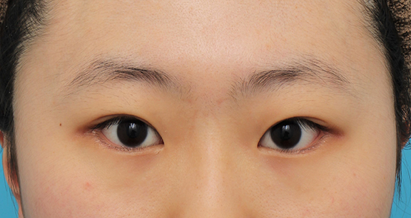 垂れ目（パンダ目）形成（グラマラスライン／下眼瞼下制術）,二重まぶた全切開法+目尻切開+たれ目形成（グラマラスライン）の症例写真,After（6ヶ月後）,ba_sekkai072_b01.jpg