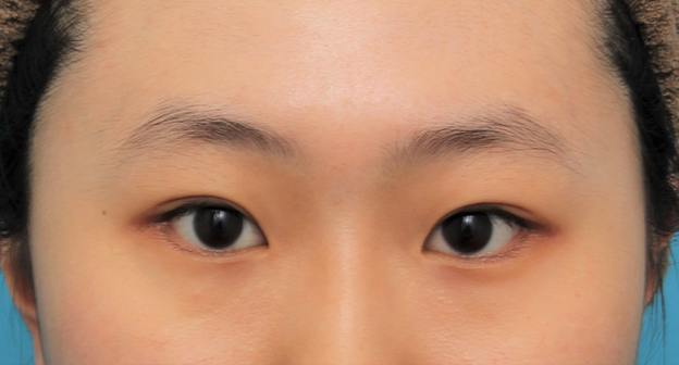 垂れ目（パンダ目）形成（グラマラスライン／下眼瞼下制術）,二重まぶた全切開法+目尻切開+たれ目形成（グラマラスライン）の症例写真,2ヶ月後,目を開けた状態,mainpic_sekkai072i.jpg