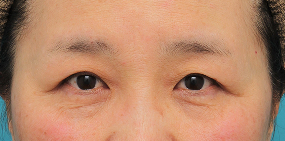 眼瞼下垂（がんけんかすい）,片目の眼瞼下垂手術を行い、左右差を治した60代女性の症例写真,After（6ヶ月後）,ba_ganken042_a01.jpg