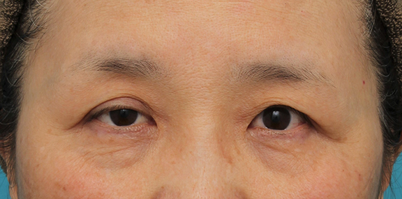 眼瞼下垂（がんけんかすい）,片目の眼瞼下垂手術を行い、左右差を治した60代女性の症例写真,Before,ba_ganken042_b01.jpg