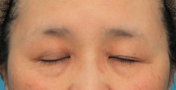 眼瞼下垂（がんけんかすい）,片目の眼瞼下垂手術を行い、左右差を治した60代女性の症例写真,Before,ba_ganken042_b02.jpg