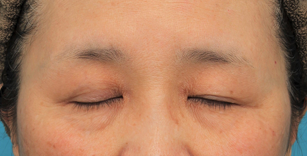眼瞼下垂（がんけんかすい）,片目の眼瞼下垂手術を行い、左右差を治した60代女性の症例写真,手術前,mainpic_ganken042b.jpg