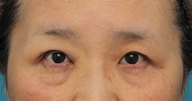 症例写真,片目の眼瞼下垂手術を行い、左右差を治した60代女性の症例写真,手術直後,mainpic_ganken042c.jpg