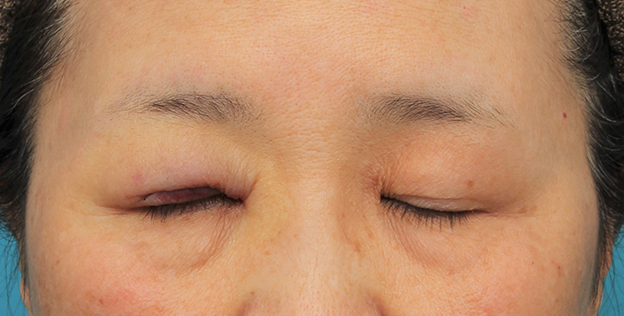 眼瞼下垂（がんけんかすい）,片目の眼瞼下垂手術を行い、左右差を治した60代女性の症例写真,手術直後,mainpic_ganken042d.jpg