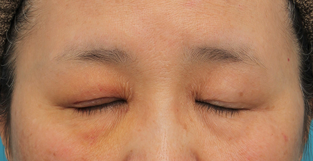 眼瞼下垂（がんけんかすい）,片目の眼瞼下垂手術を行い、左右差を治した60代女性の症例写真,6日後,mainpic_ganken042f.jpg