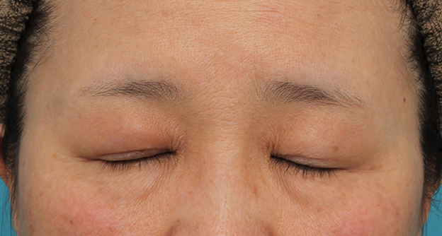 眼瞼下垂（がんけんかすい）,片目の眼瞼下垂手術を行い、左右差を治した60代女性の症例写真,3週間後,mainpic_ganken042h.jpg