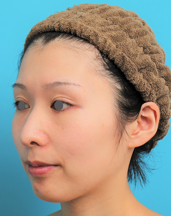 あご形成（シリコンプロテーゼ）,顎にシリコンプロテーゼを入れた20代女性の症例写真,After（6ヶ月後）,ba_ago022_b02.jpg