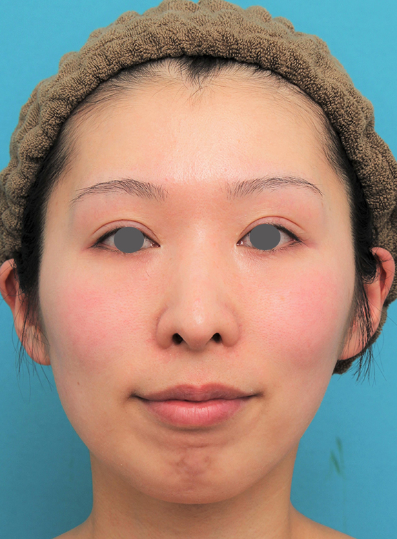 あご形成（シリコンプロテーゼ）,顎にシリコンプロテーゼを入れた20代女性の症例写真,Before,ba_ago022_b01.jpg