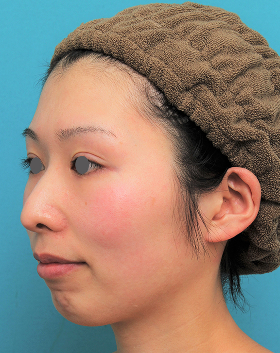 あご形成（シリコンプロテーゼ）,顎にシリコンプロテーゼを入れた20代女性の症例写真,Before,ba_ago022_b02.jpg