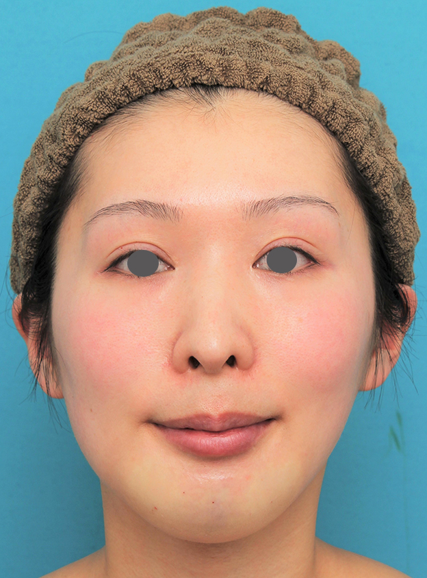 あご形成（シリコンプロテーゼ）,顎にシリコンプロテーゼを入れた20代女性の症例写真,手術直後,mainpic_ago022b.jpg