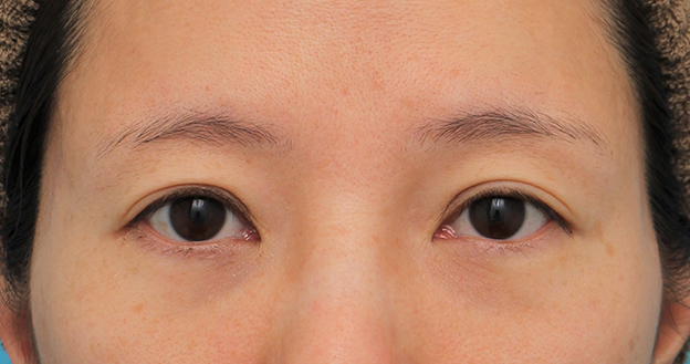 目の下の脂肪取り,目の下の脂肪の膨らみを取り、クマを改善させた30代女性の症例写真,6ヶ月後,mainpic_shibo14f.jpg